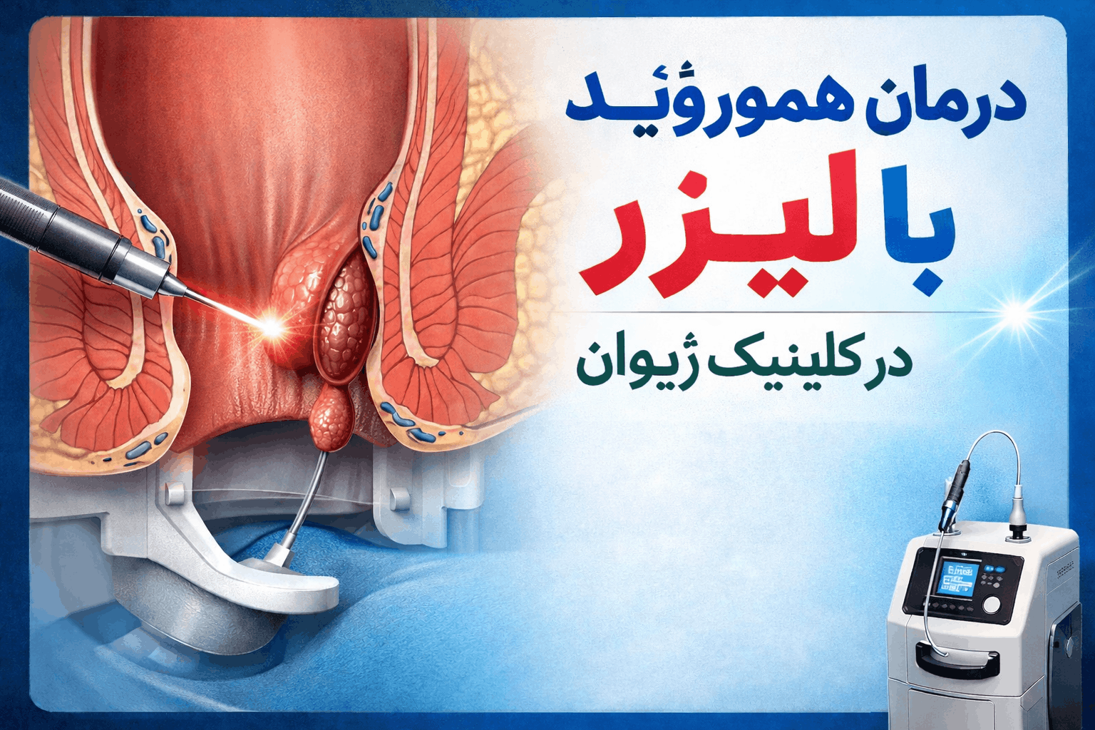 درمان هموروئید با لیزر در کلینیک ژیوان