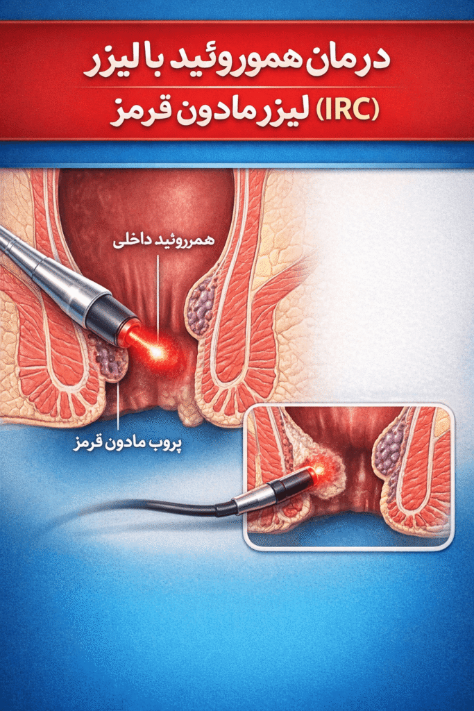 درمان هموروئید (بواسیر) با لیزر مادون قرمز (IRC)