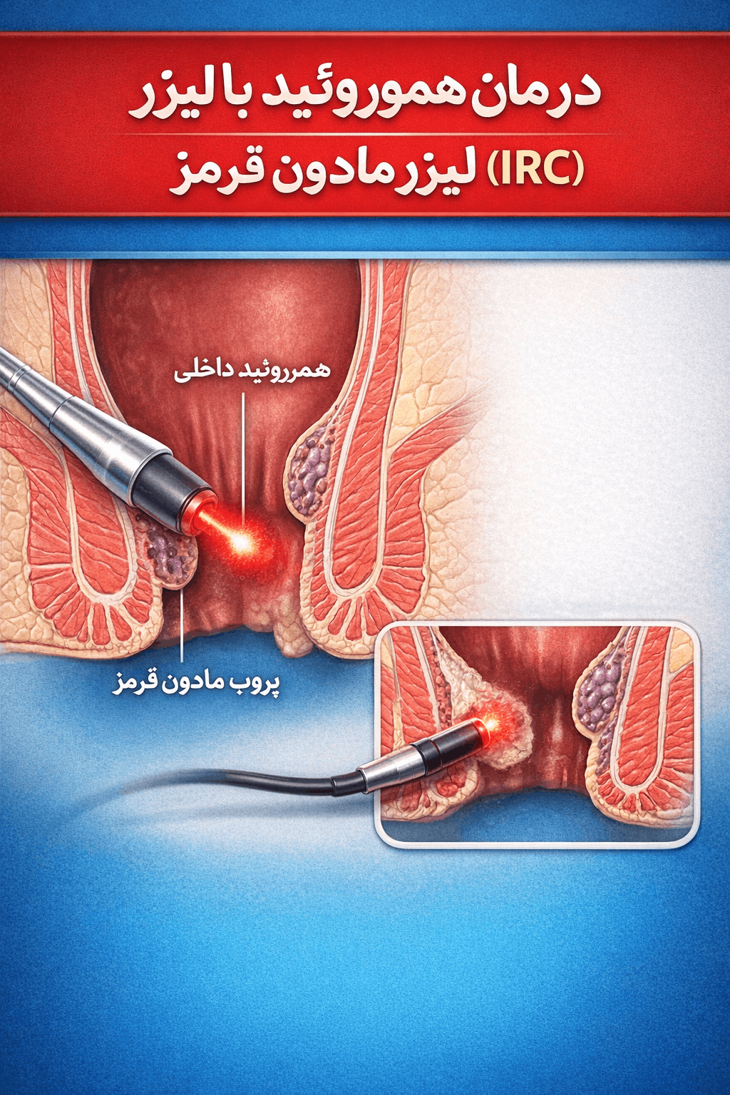 درمان هموروئید (بواسیر) با لیزر مادون قرمز (IRC)
